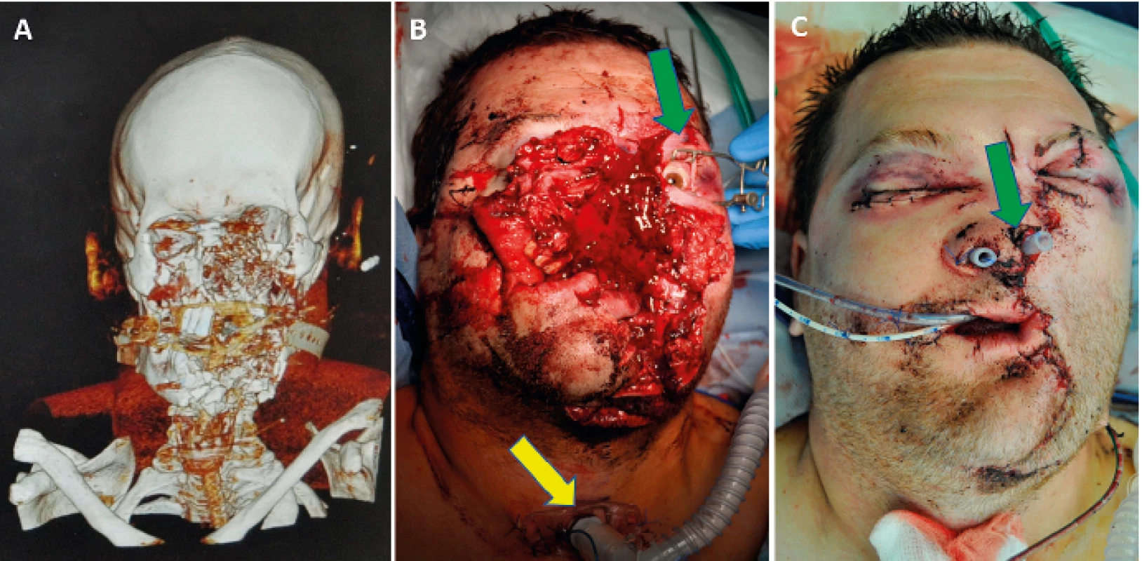 A) CT examination of the same patient with a gunshot injury to the face (intubated through the mouth); the scan shows a comminuted fracture of the lower jaw and a loss injury to the maxilla. B) Eye globe examination using an eyelid opener (green arrow) and tracheostomy (yellow arrow) C) Reconstructed face, the green arrow indicates tubes used for nose reconstruction