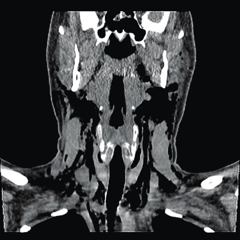 CT snímek krku (koronární rovina)