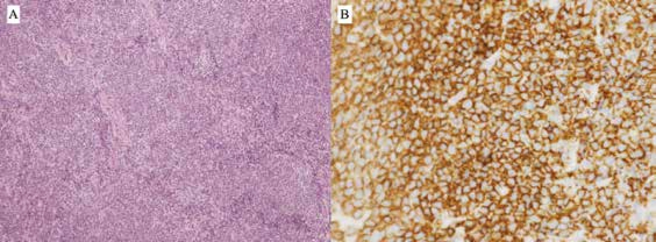 Pacient 1 – B-NHL typu MCL, bioptický nález: <br>A) Infiltrácia mäkkých tkanív denznou, pseudonodulárne rastúcou nádorovou lymfoproliferáciou z malých až stredne veľkých lymfoidných buniek (HE, zv. 100x) <br>B) Imunohistochemická pozitivita znaku CD20+ v nádorových bunkách (zv. 400x)
