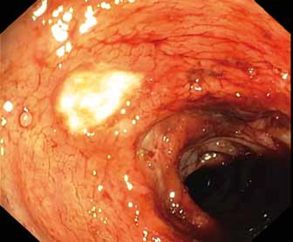 Okrouhlé ulcerace s fibrinem v colon descendens.<br> Fig. 3. Round ulceration with fibrin on the surface in the descending colon.