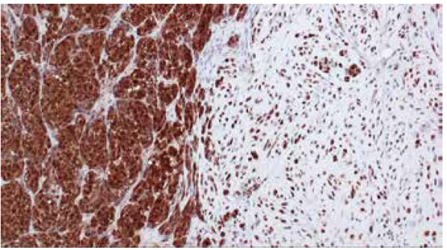 Imunohistochemická exprese S100 proteinu v nádorových melanocytech
a v chrupavce (IHC, zvětšeno 10x).