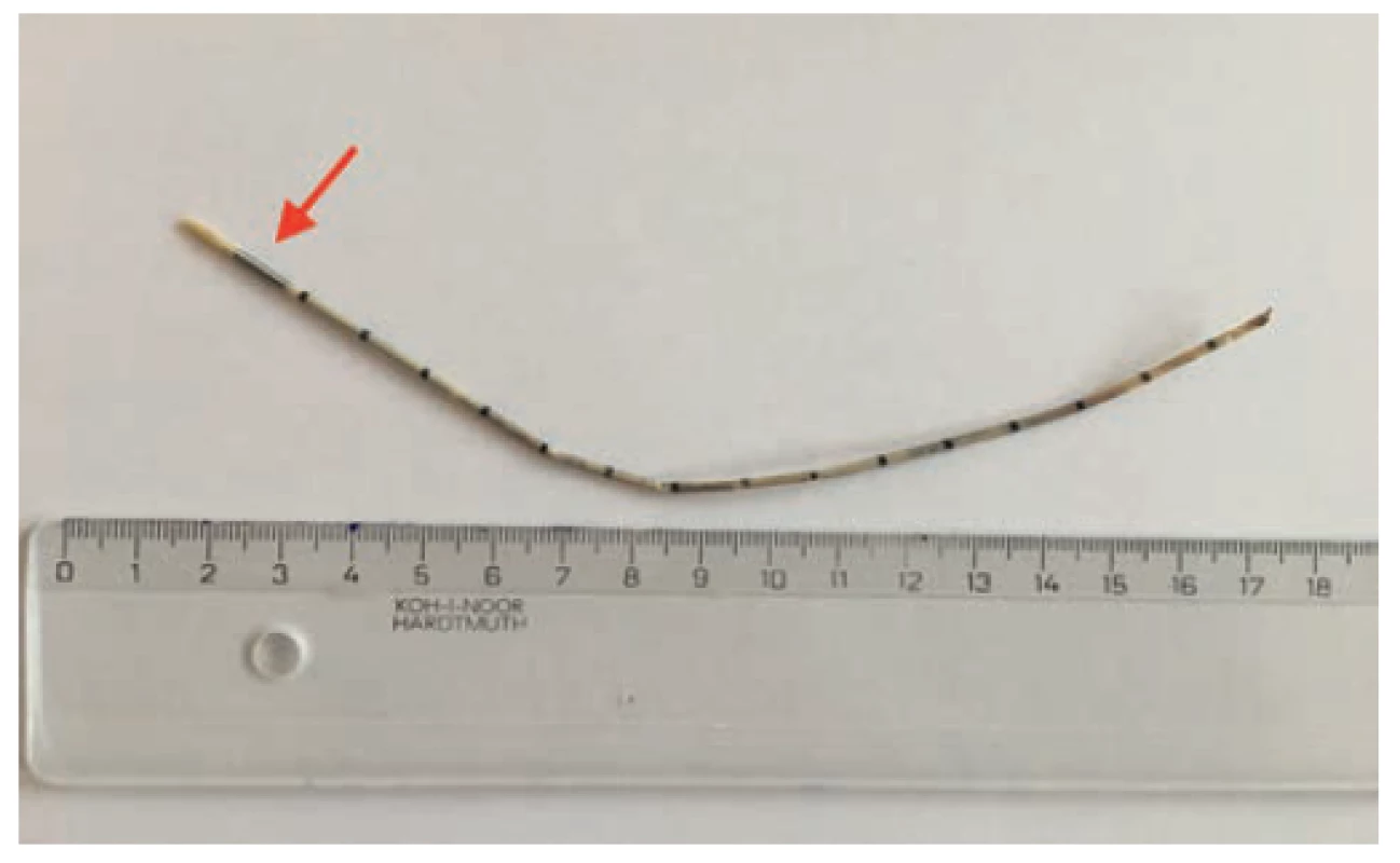 Extrahovaný zvyšok katétra o dĺžke takmer 20cm<br>
Fig. 3. Extracted catheter remnant with a size of almost
20cm