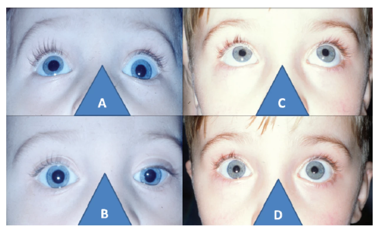 3-letý chlapec s levostrannou párezou elevátorů: porucha
elevace vlevo (A) při stejnostranné hypotropií před operaci
cul-de-sac (B), a oboustranně volná elevace (C) s paralelním postavení
očí po dvou letech od operace (D)