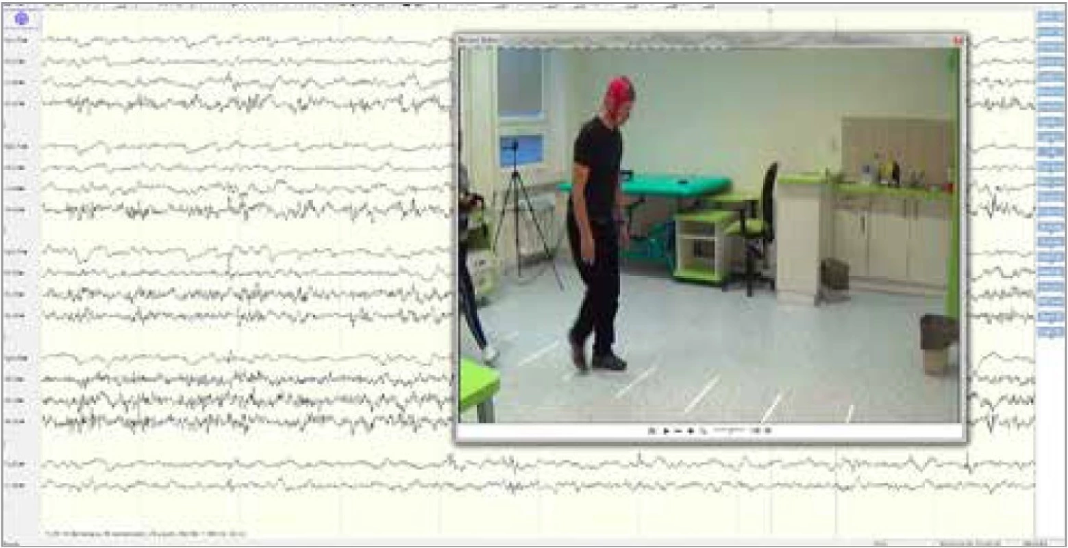 Ukázka z měření EEG při chůzi facilitované zevním zrakovým podnětem
u pacienta s Parkinsonovou nemocí. Zdroj: archiv autorky.<br>
Fig. 1. A demonstration of EEG recording during walking facilitated by external
visual cue in Parkinson’s disease patient. Source: author’s archive.