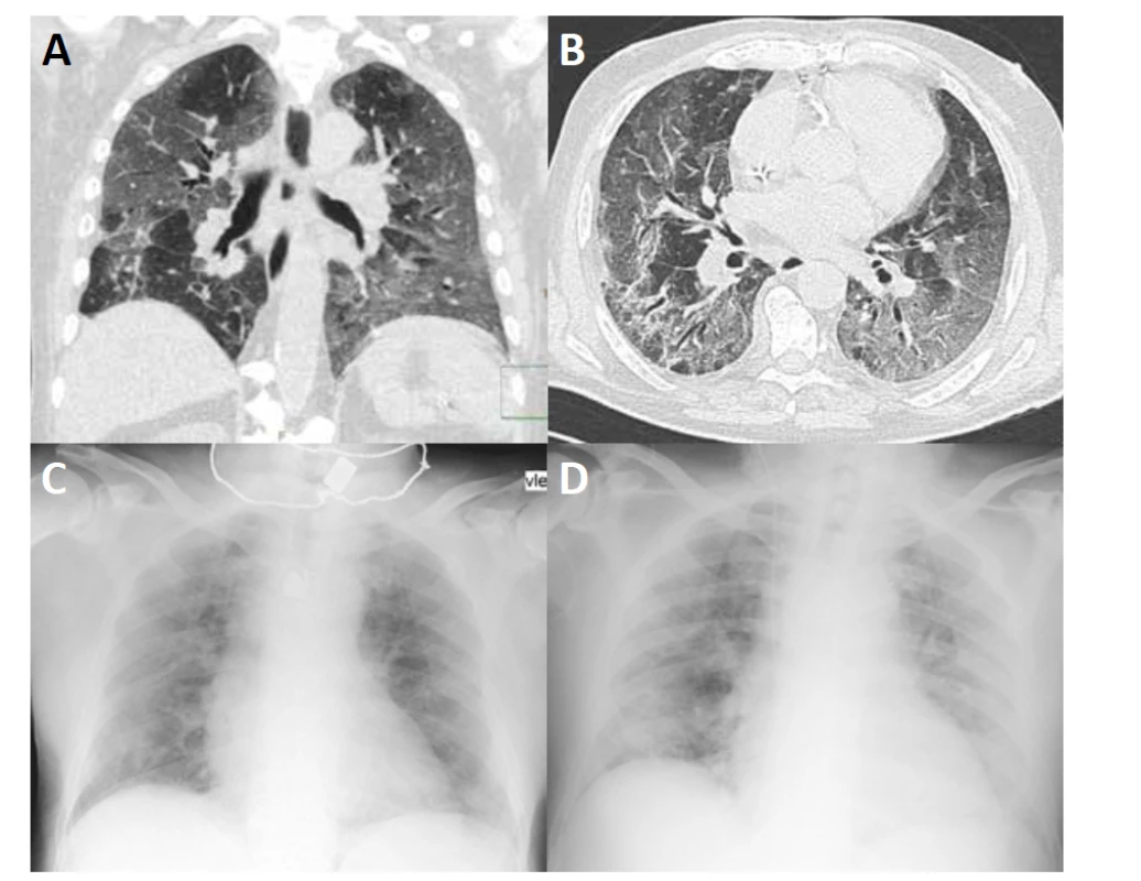 HRCT hrudníku (A, B) ukazuje rozsáhlé oblasti vyšší denzity typu „mléčného skla“ (ground glass opacities) se
zesílením interlobulárních sept v parenchymu obou plicních křídel s relativním ušetřením centrální části plic. V dolních
lalocích jsou zachyceny bronchiektázie (B). Na RTG (C, D) je patrná snížená transparence především v periferní části obou plicních křídel.