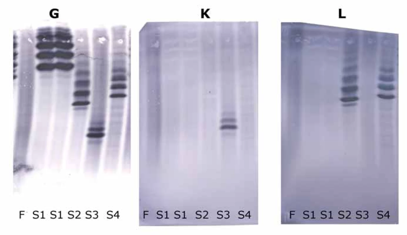 Výsledky detekce těžkých řetězců imunoglobulinu gama (G), lehkých řetězců imunoglobulinu kappa (K) a lambda (L) pomocí
izoelektrické fokusace s následným afi nitním imunoblottingem.
F – intravenózní preparát IgG (Flebogamma, Instituto Griffols, Barcelona, Španělsko), S1 – náš pacient, S2 a S4 – vzorky séra s monoklonálním
IgG lambda, S3 – vzorek séra s monoklonálním IgG kappa.
V S1 lze nalézt pouze monoklonální pásy těžkého řetězce gama, lehké řetězce kappa a lambda jsou negativní. Výsledky naznačují pouze
přítomnost těžkého řetězce gama. Pro další potvrzení jsme použili SDS elektroforézu (umožňuje rozlišit molekuly podle molekulové
hmotnosti).
