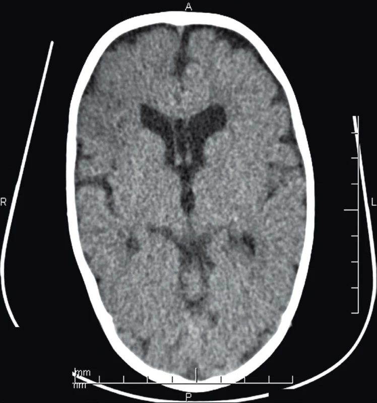 CT mozgu (vo veku 8 mes.) – vpravo frontálne, nehomogénna
škvrnitá hypodenzná area veľkosti 2,5 x 2
cm.<br>
Fig. 1. Brain CT (age 8 months) – non-homogenous spotty hypodense
area 2.5 x 2 cm in the right frontal lobe.