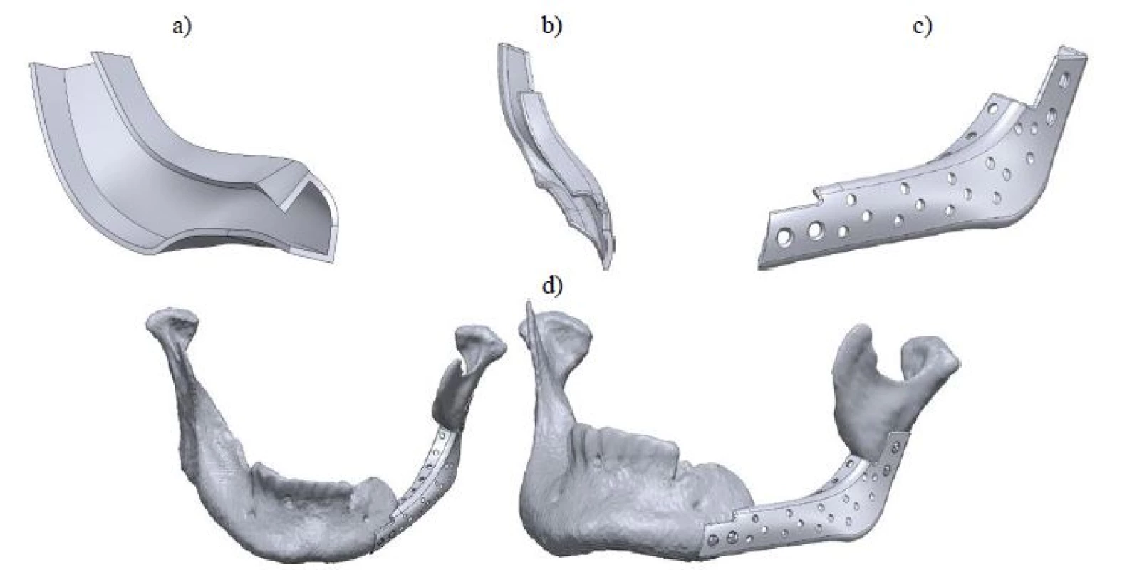 Modeling procedure of the mandibular implant showing a) hollowed shell by 1mm thickness, b) fixation support, c) perforated mandibular implant and d) mounted implant on the reconstruction site, fixed with 4 titanium screws.