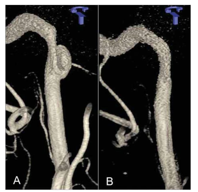Arteria carotis interna.<br>
a) aneuryzmatické rozšírenie so stenózou, b) po endovaskulárnej liečbe, 3D DSA.<br>
Fig. 2. Internal carotid artery.<br>
a) aneurysmal enlargement with stenosis, b) after endovascular treatment, 3D DSA.