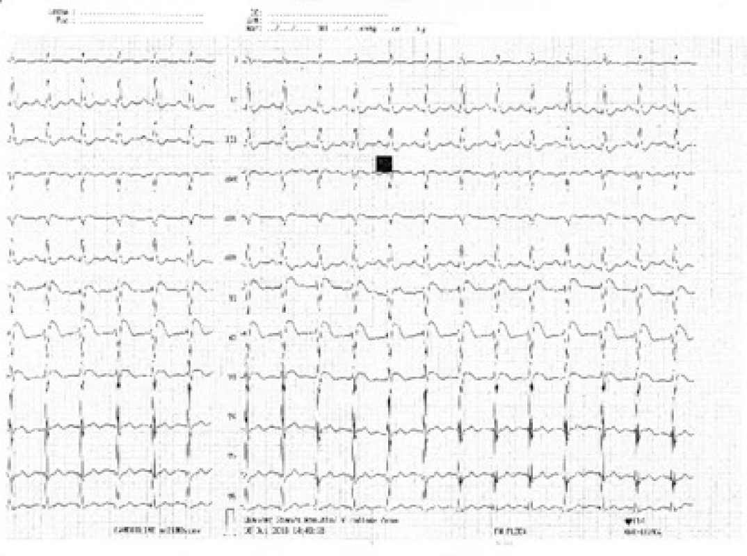 Obr. 1. Křivka EKG při přijetí