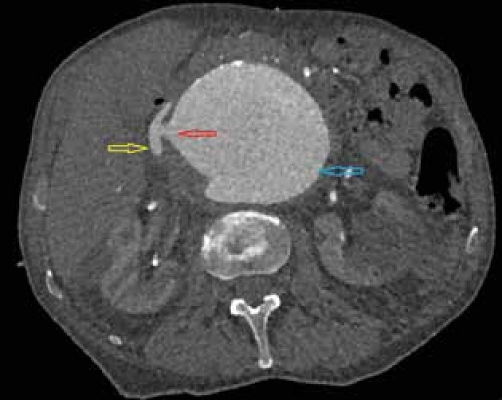 CT angiografie, axiální řez
Žlutá šipka − vena cava inferior, červená šipka − aorto-kavální
píštěl, modrá šipka - aneuryzma subrenální aorty. <br>
Fig. 1: CT angiography, axial cross-section
Yellow arrow − vena cava inferior, red arrow − aorto-caval fistula, blue arrow - infrarenal aortic aneurysm.