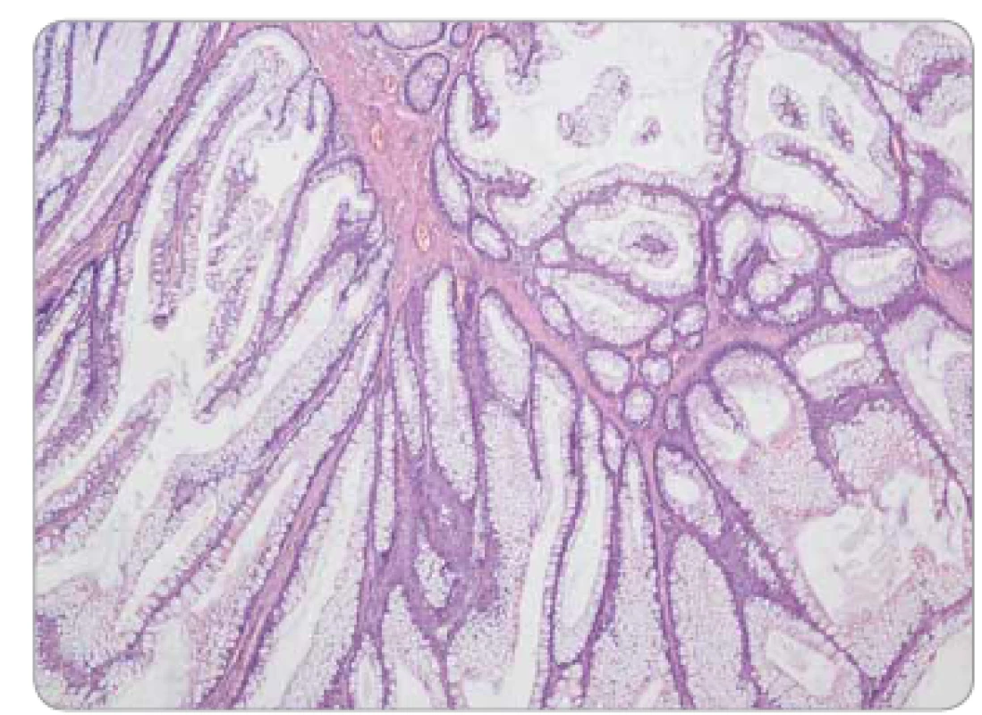 Peutzův-Jeghersův polyp tračníku – stromečkovitě větvené
výběžky muscularis mucosae, epiteliální výstelka tvořena
normálními enterocyty a pohárkovými buňkami sliznice colon,
bez dysplazie.
