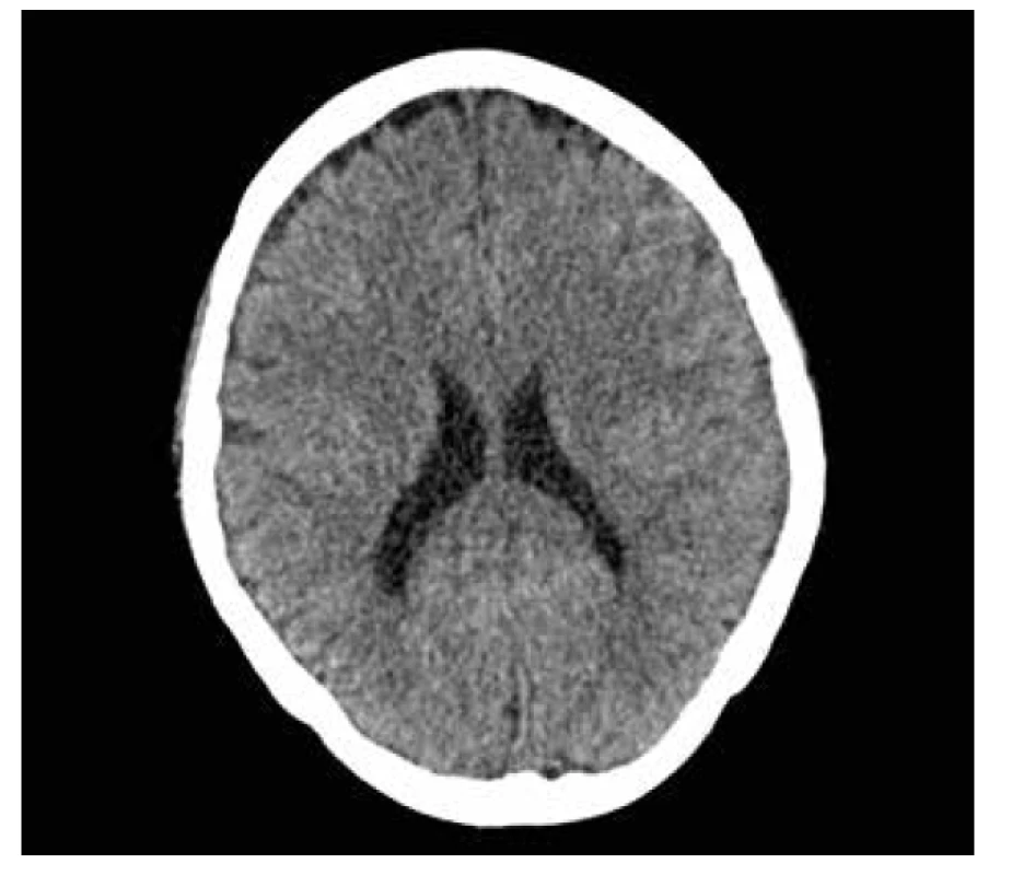 CT hlavy, transverzální řez, bilaterální plášťový subdurální hematom
s maximem frontoparietálně nad konvexitami hemisfér