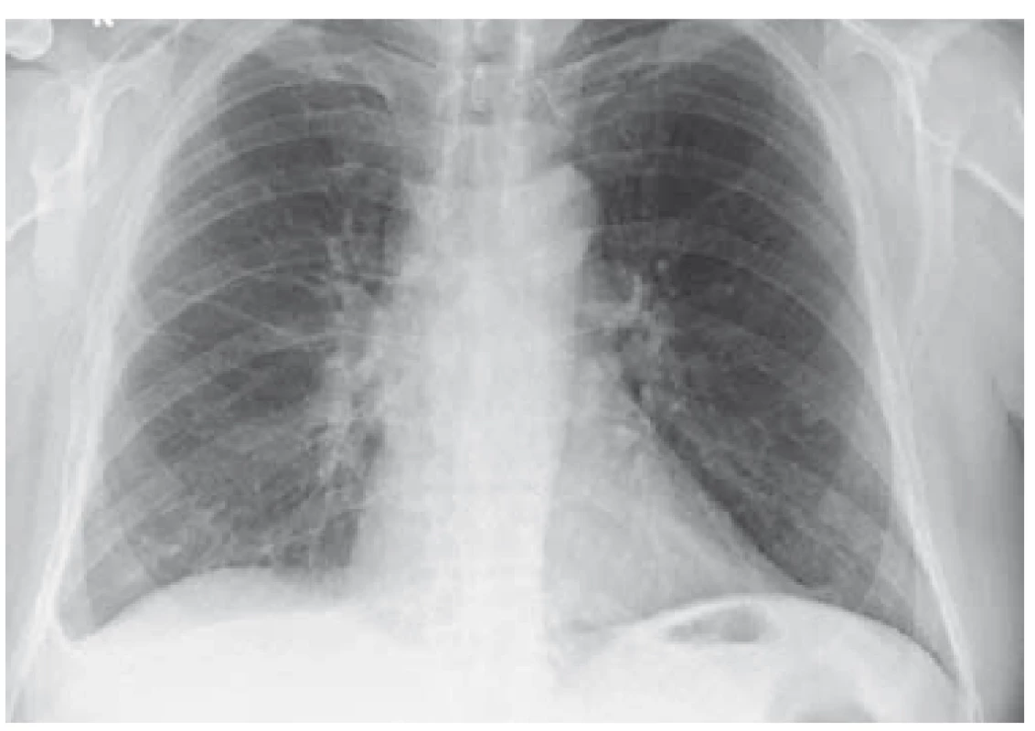 RTG plic – výpotek bazálně vpravo (6/2018).<br>
Fig. 3. Lung X-ray – basal right fluidothorax (6/2018).