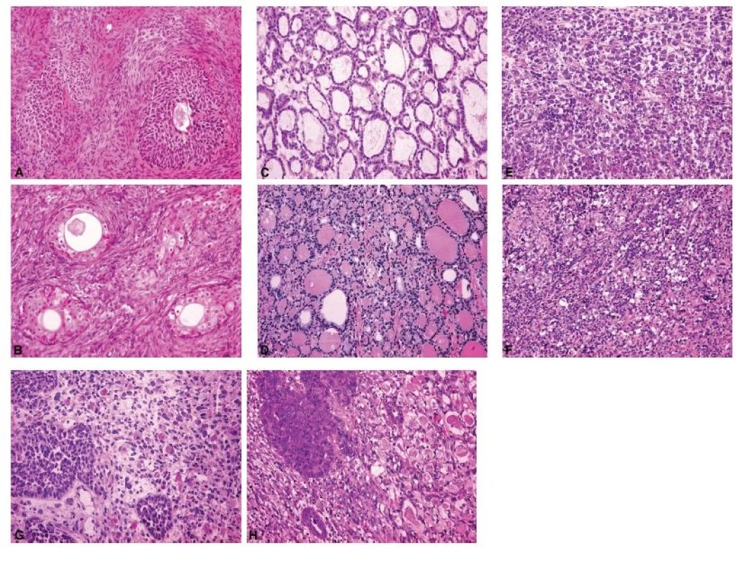 Spektrum peroperačních nálezů ovariálních nádorů různé histogeneze a biologického chování.<br>
A – Brennerův nádor (peroperační vyšetření, HE, 200x);
B – Brennerův nádor (definitivní vyšetření, HE, 200x);
C – monodermální teratom (struma ovarii) (peroperační
vyšetření, HE, 200x); D – monodermální teratom
(struma ovarii) (definitivní vyšetření, HE, 200x);
E – dysgerminom (peroperační vyšetření, HE, 200x);
F – dysgerminom (definitivní vyšetření, HE, 200x);
G – maligní smíšený Mülleriánský nádor (karcinosarkom)
s rhabdomyoblastickou komponentou (peroperační
vyšetření, HE, 200x); H – maligní smíšený Mülleriánský
nádor (karcinosarkom) s rhabdomyoblastickou
komponentou (definitivní vyšetření, HE, 200x)
