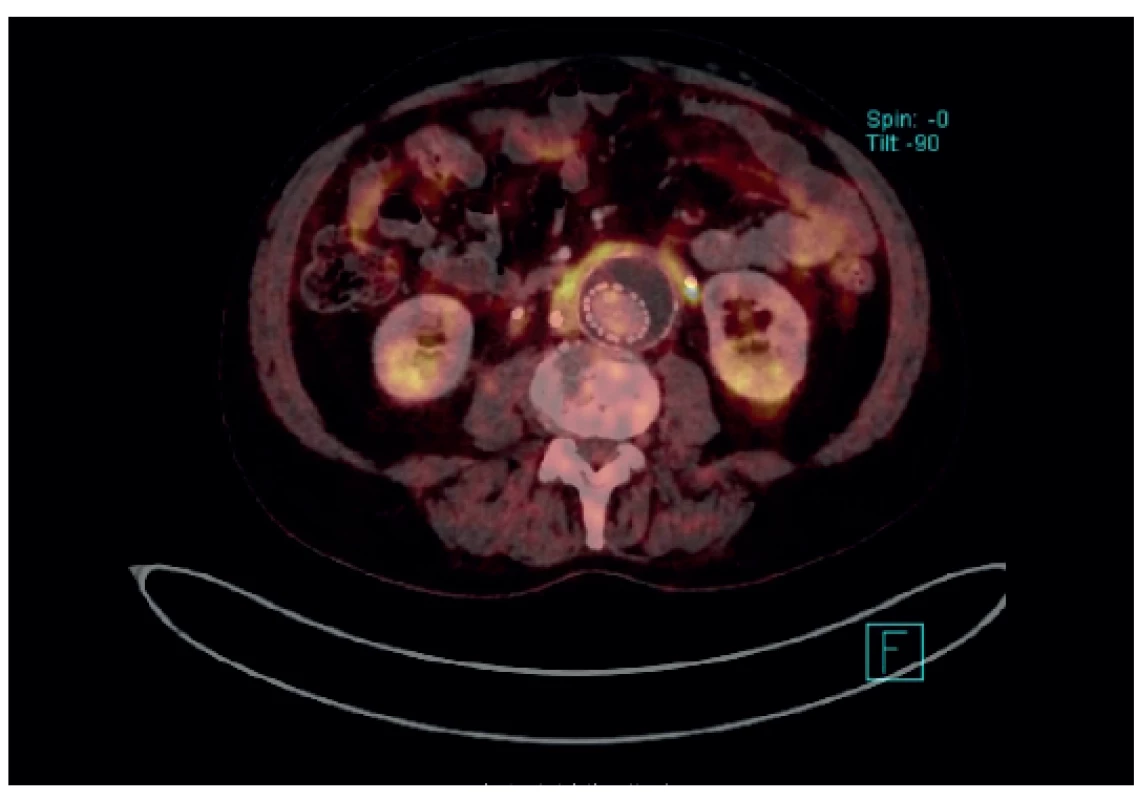 PET/CT – EVAR in AAA with retroperitoneal fibrosis
