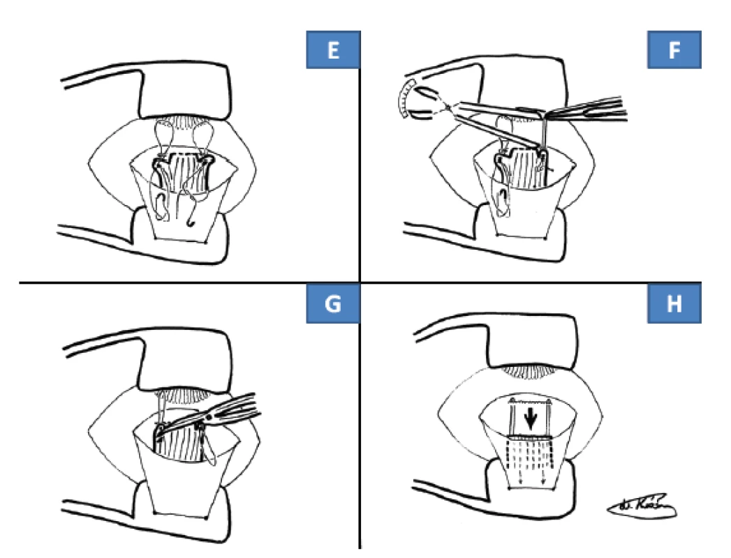 Operační technika cul-de-sac: protažení stehu do odstřiženého
úponu (E), změření kličky stehu, jeho fixace (F), odstřižení
střední části úponu (G), spontánní uvolnění svalu (H)