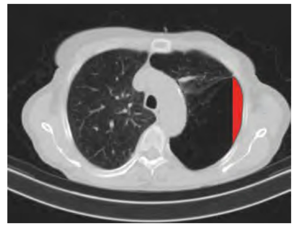 CT z obrázku 2, červeně zdůrazněna radiolucentní oblast, která při
snímkování sagitálním paprskem imituje pneumotorax