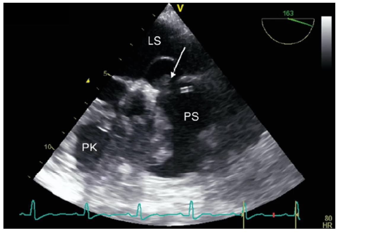 Transezofageální echokardiografie. Šipka ukazuje PFO s ukotvením
trombu, který zasahuje do pravé síně i pravé komory. LS – levá síň, PS – pravá
síň, PK – pravá komora