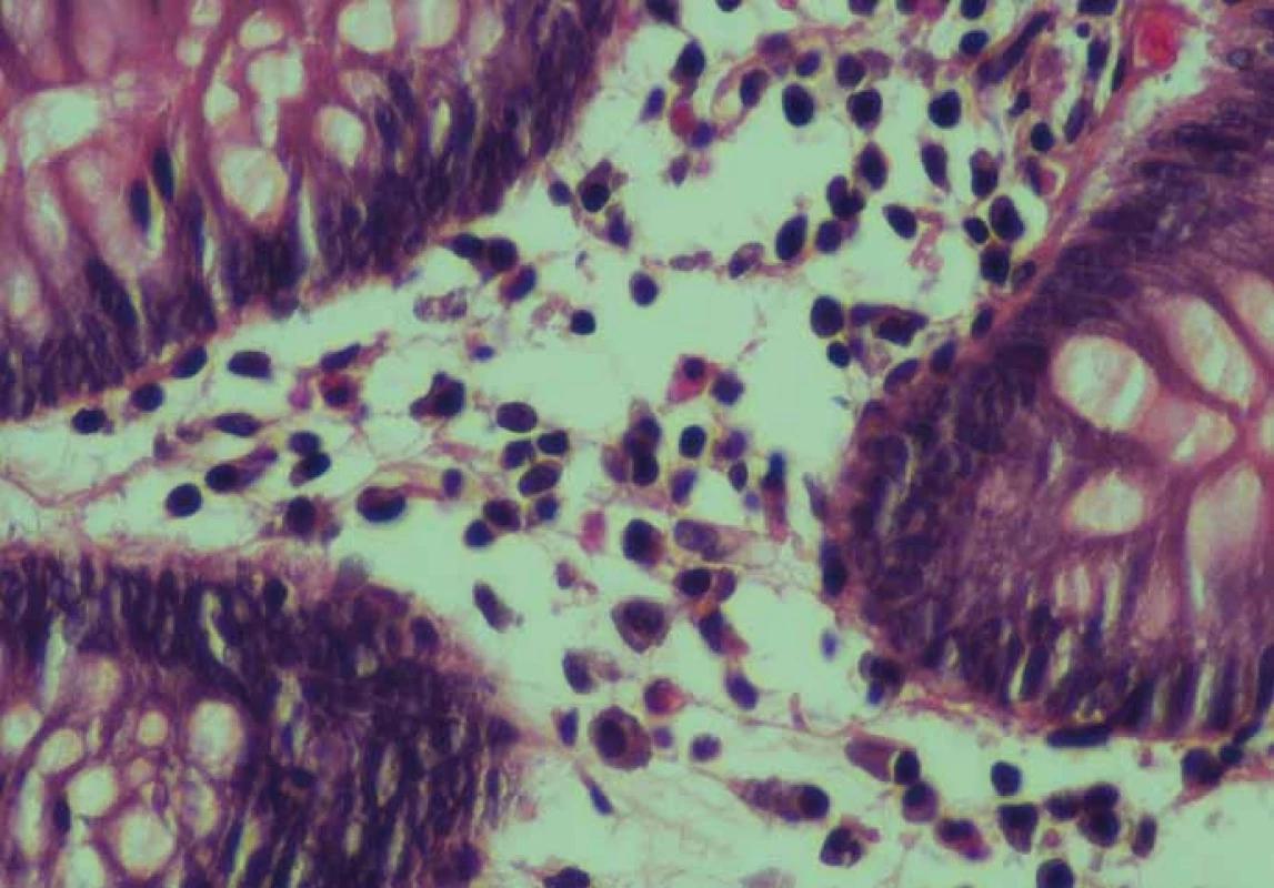 Detail zánětlivé celulizace v lamina propria střevní sliznice s mastocyty (barvení hematoxylin-eozinem, zvětšení 60×).<br>
Fig. 1. Detail of the colon mucosa with increased inflammatory cells in the lamina
propria with mast cells (Haematoxylin and eosin staining, enlargement 60×).