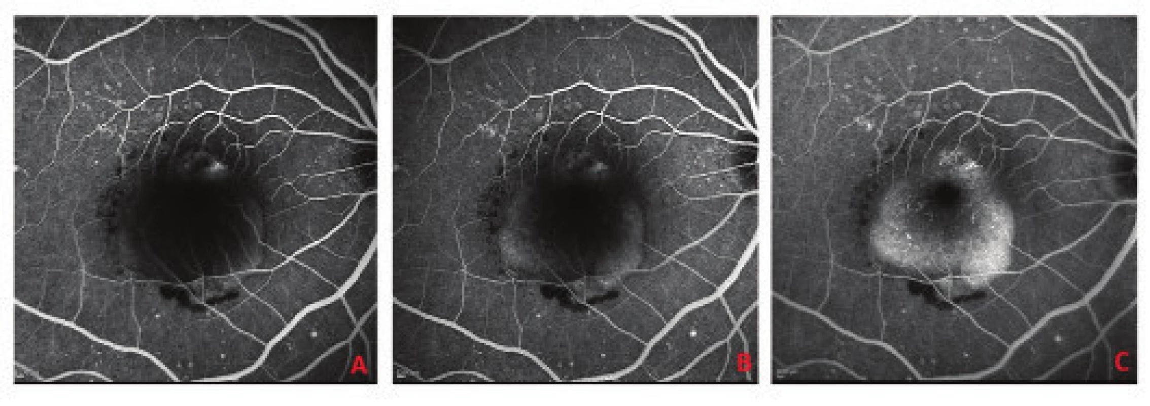 Fluorescence angiography at baseline examination<br>
A. Early phase of fluorescence angiography identifying hyperfluorescent lesion of choroidal neovascularisation with infiltration on the upper edge of the lesion, peripheral filling of RPE detachment, on
lower edge evident hypofluorescence corresponding to haemorrhage<br>
B. Middle phase with progressive filling of deposit of RPE detachment with fluorescein<br>
C. Late phase identifying homogeneous hyperfluorescence with sharp edges