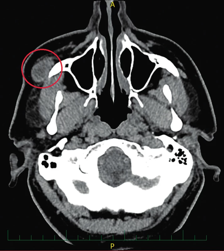 Předoperační CT hlavy, axiální projekce – nodulární fasciitida při jařmovém oblouku vpravo velikosti 15 × 19 × 22 mm (vyznačeno červeně)