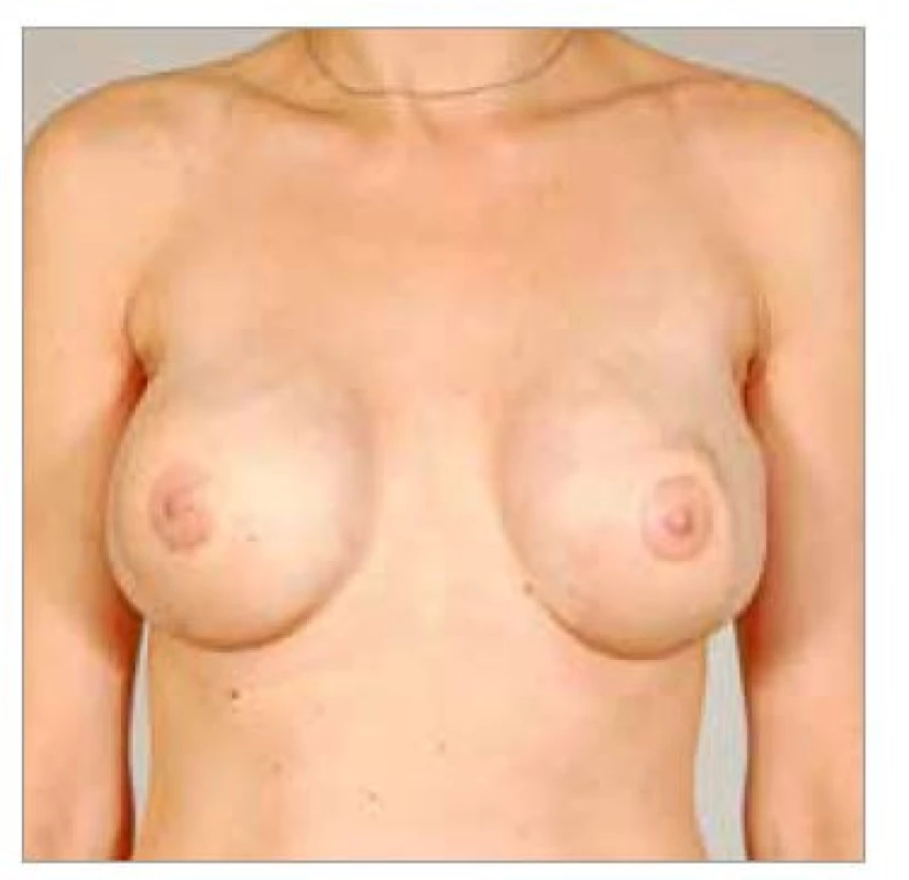 Fig. 8. Patient No. 4 – final result
of healed LDM flaps bilateral
application, nipple-areolar complex
reconstruction and implants.