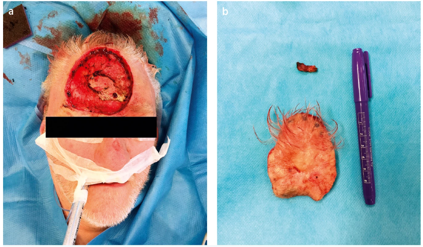 a. Perioperative state, wide and radical local excision of the lesion with >1cm peripheral margins<br>
Fig. 2. b. Resection specimen (7.5 x 6.0 x 0.8 cm)
