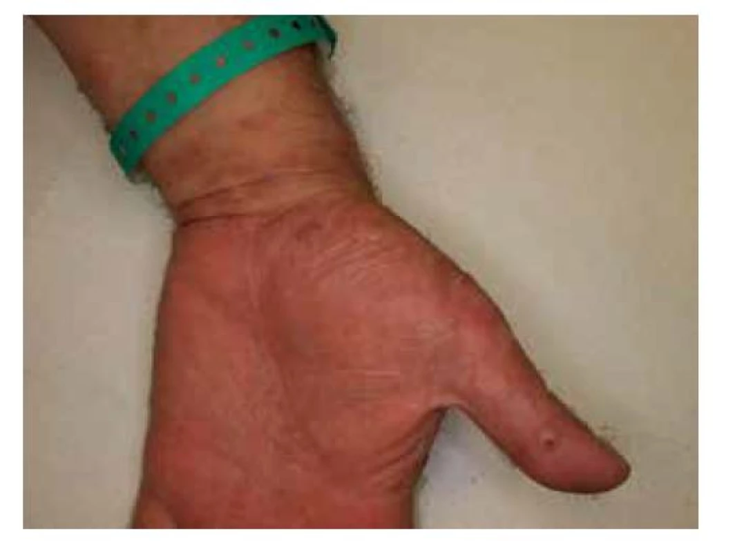 Puchýře na dlani u pacienta s bulózním pemfigoidem
po očkování