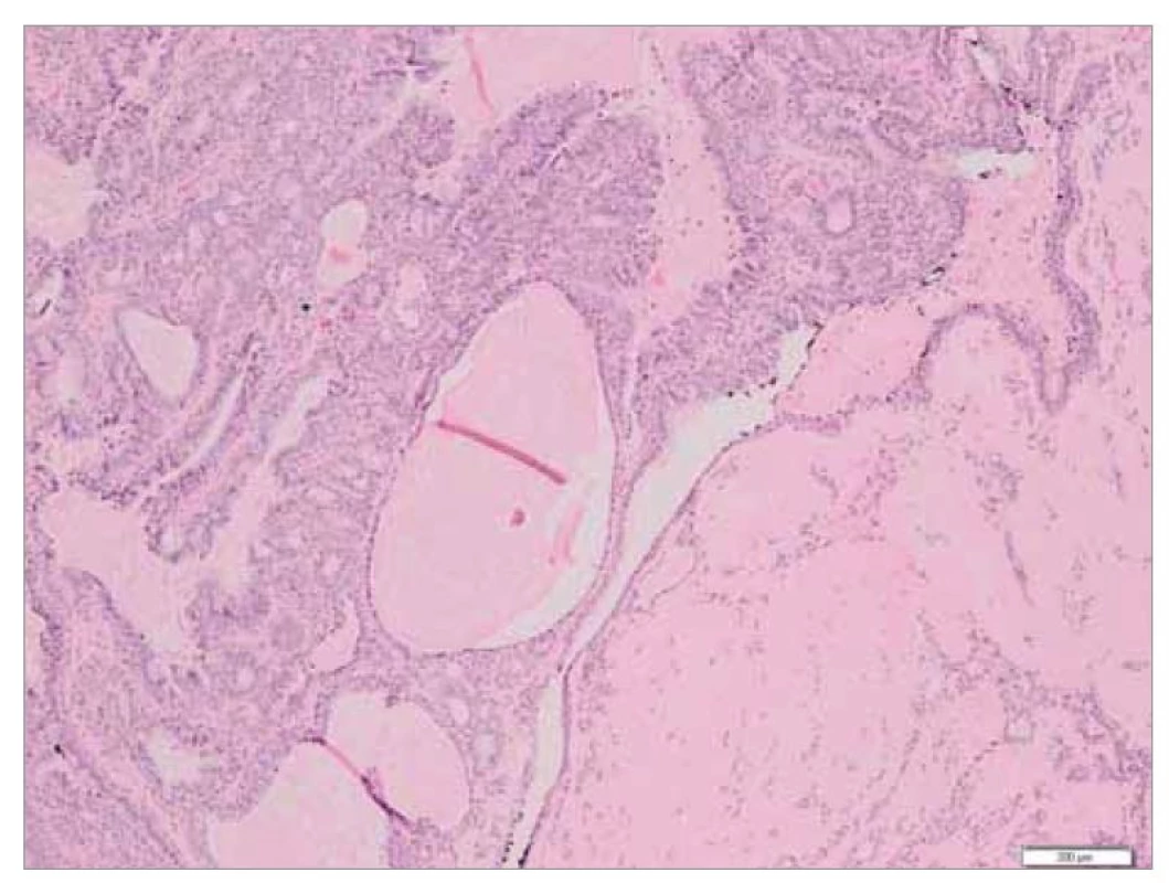 Histopatologický obraz epitelio-myoepiteliálního karcinomu, neoplastická
populace tvořena tubulárně utvářenými strukturami s bifázickým vzhledem
– v periferii tubulů myoepitelovými buňkami, v luminální části epitelovými
buňkami, barvení HE (zvětšení 40x).<br>
Fig. 2. Histopathological picture of epithelio-myoepithelial carcinoma, neoplastic
population formed by tubularly formed structures with biphasic appearance – in
the periphery of the tubules by myoepithelial cells, in the luminal part by epithelial
cells, HE staining (magnification 40x).
