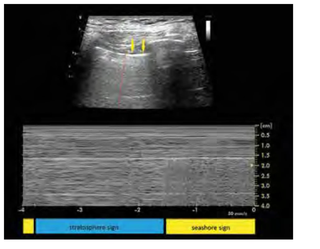 Snímky z ultrazvukového přístroje zachycující bleb point, tedy
plicní bulu obklopenou zdravou plicní tkání. Jedná se ilustrační obrázek
od jiného pacienta.<br>
V horní části obrázku vidíme zobrazení v B‑módu,
žluté šipky ukazují vertikální
artefakty dokazující přítomnost plíce, červená čára zdůrazňuje hranici
mezi bulou vlevo a normální plicní tkání vpravo. Statický obrázek nezachytí
pleurální sliding, který byl při vyšetření patrný napravo od červené čáry.<br>
V dolní části obrázku je M‑mód
zaznamenaný v linii červené čáry z horního
obrázku, je jasně patrno rytmické střídání obrazu buly – stratosphere sign –
s obrazem normální plicní tkáně – seashore sign