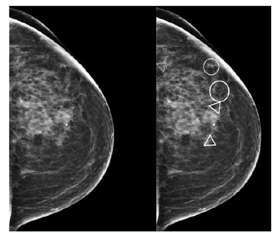 Umělá inteligence na mamografickém snímku
identifikuje změny, které jsou malé, lidským okem téměř
neviditelné.