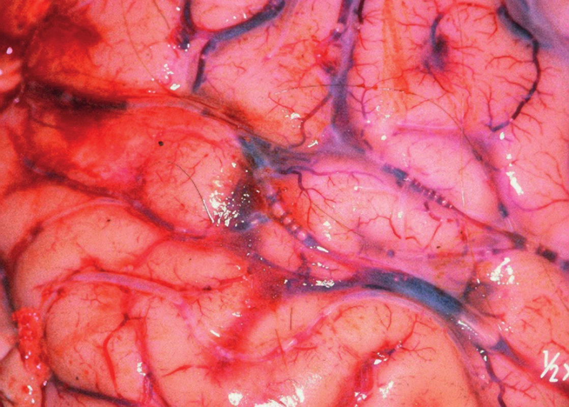 Masivní plynová embolie mozkových cév při přetlakovém barotraumatu plic (podle (14)) 