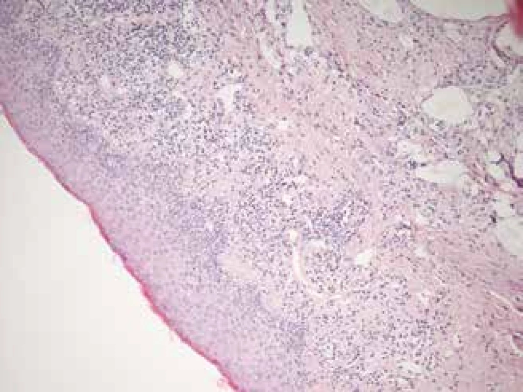 Histological sample from edge of left eyelid, taken
during partial tarsorrhaphy in 2017. Similar histological
features attesting to lichenoid changes as in fig. 1, with
lymphocytic infiltration of subepithelial conjunctiva