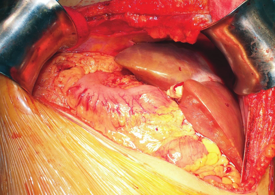 Probatory placement of the rotated reduced graft
in the hepatic fossa<br>
The resection plane is located under the diaphragm; the left
lateral segment points to the left hypogastrium. The picture
was taken before reperfusion of the graft.