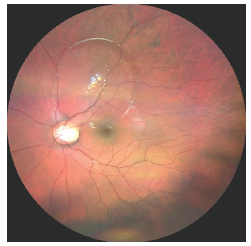 Foto fundu levého oka, JTZN se serózní ablací
neuroretiny superotemporálně