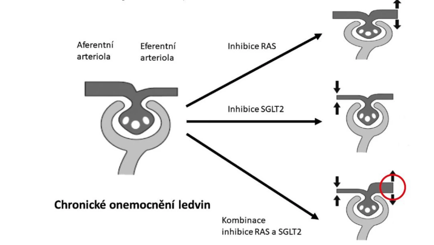 Vliv inhibitorů RAS a SGLT2 na glomerulární hemodynamiku