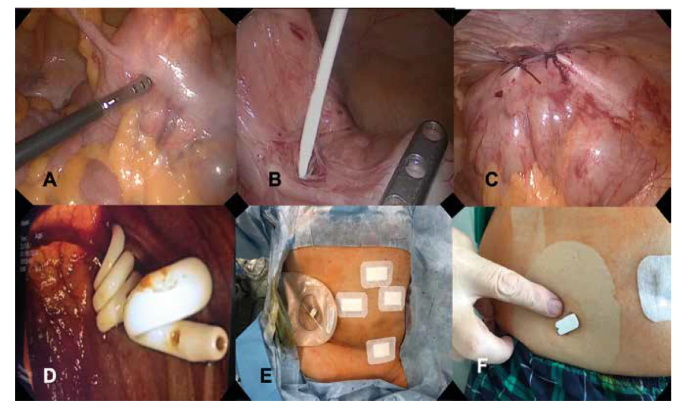 LAPEC procedúra:<br>
A) laparoskopická verifikácia céka s kolonoskopickou diafanoskopiou pred inserciou katétra, B) insercia katétra do tenia libera, C)
plikácia steny céka so zavedeným katétrom k brušnej stene, D) endoskopický obraz. pigtail katétra v lumene céka, E) pooperačný
nález so stómickým vakom, F) knoflík cekálneho katétra na brušnej stene druhý pooperačný deň.<br>
Fig. 1: LAPEC procedure:<br>
A) laparoscopic view of colonic diaphanoscopy prior to catheter insertion; B) catheter insertion into tenia libera; C) cecal wall
plication with inserted catheter to abdominal wall; D) endoscopic view of pigtail catheter in caecum; E) postoperative finding
with stoma bag, F) catheter button on abdominal wall on POD2.
