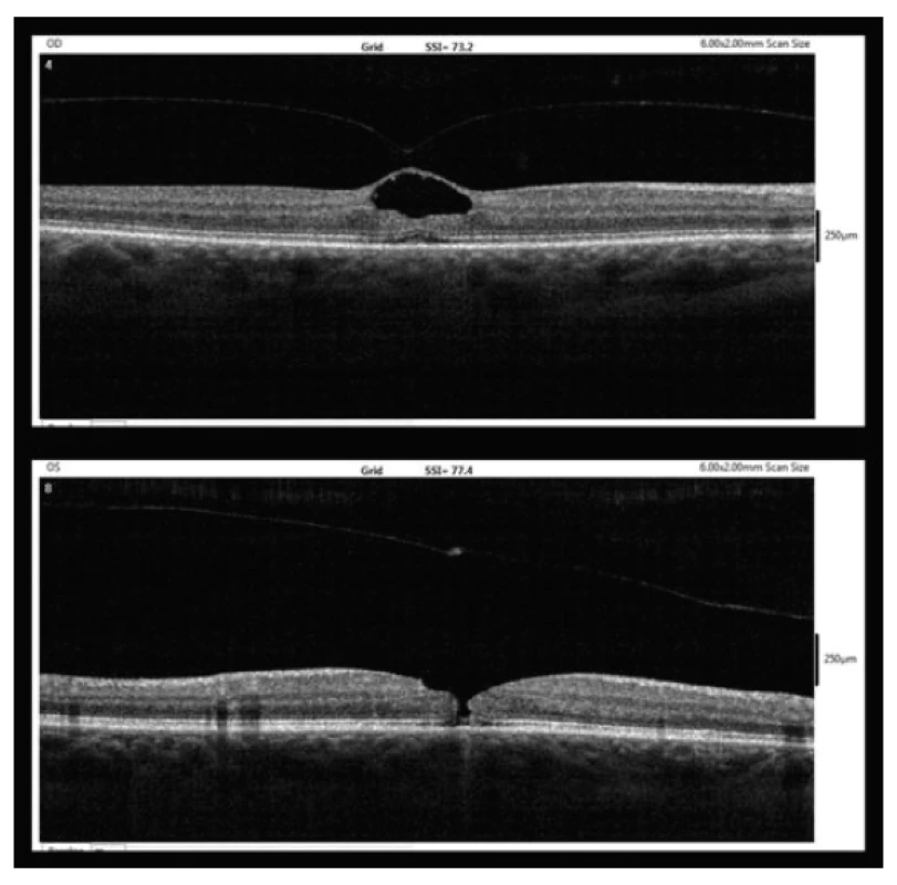 OCT findings after five weeks (9/2017, upper – right eye,
lower – left eye)