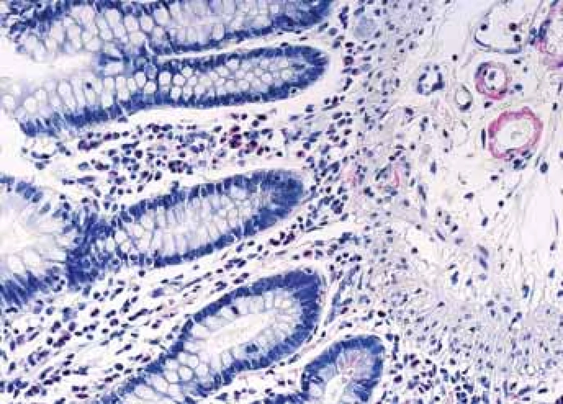 Histologické nálezy u pacientů s IBD a renálním postižením (tubulointersticiální nefritida, glomerulonefritida, AA amyloidóza).<br>
Fig. 7. Biopsy pictures in IBD patients with renal illness
(tubulointerstitial nephritis, glomerulonephritis,
AA amyloidosis).
