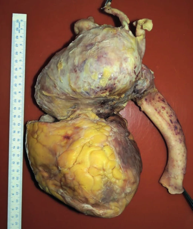 The front view of the heart and aneurysmal enlargement of the aorta.