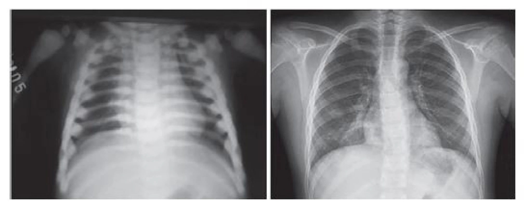 Srovnání rentgenového nálezu u chlapce s MIOP v době
stanovení diagnózy a 8 let po transplantaci