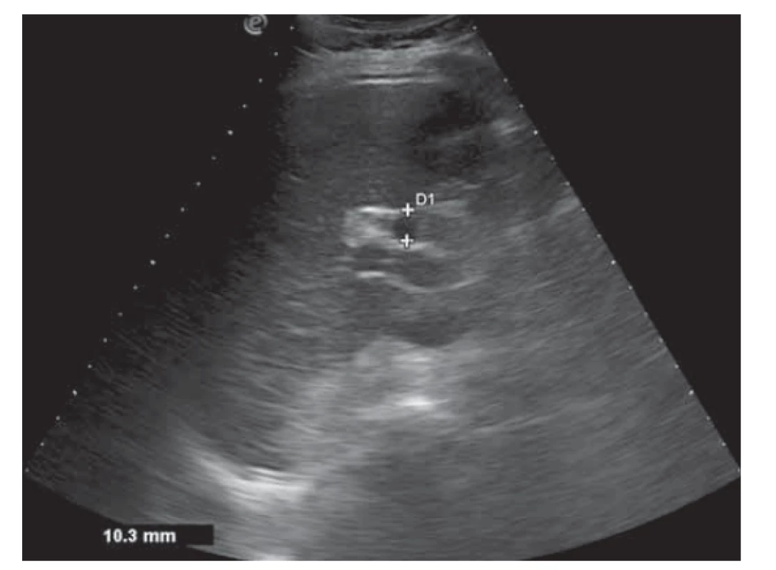 USG nález dilatácie ductus choledochus (pred zahájením
liečby).<br>
Fig. 2. USG finding of dilatation of common bile duct
(before treatment).