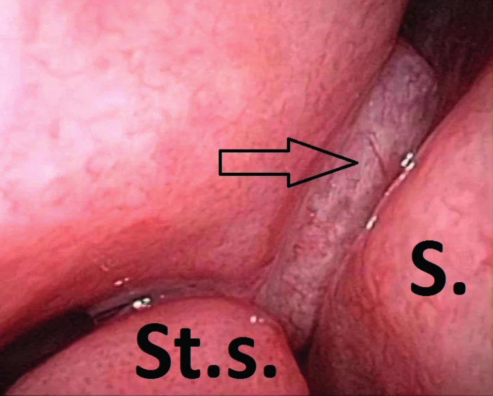 Endoskopie nosní dutiny. Šipka ukazuje na polyp
(REAH) ve stropu pravé poloviny nosní dutiny. MR tohoto pacienta
na obrázku 3.<br>
S. - septum, St. s. - střední skořepa