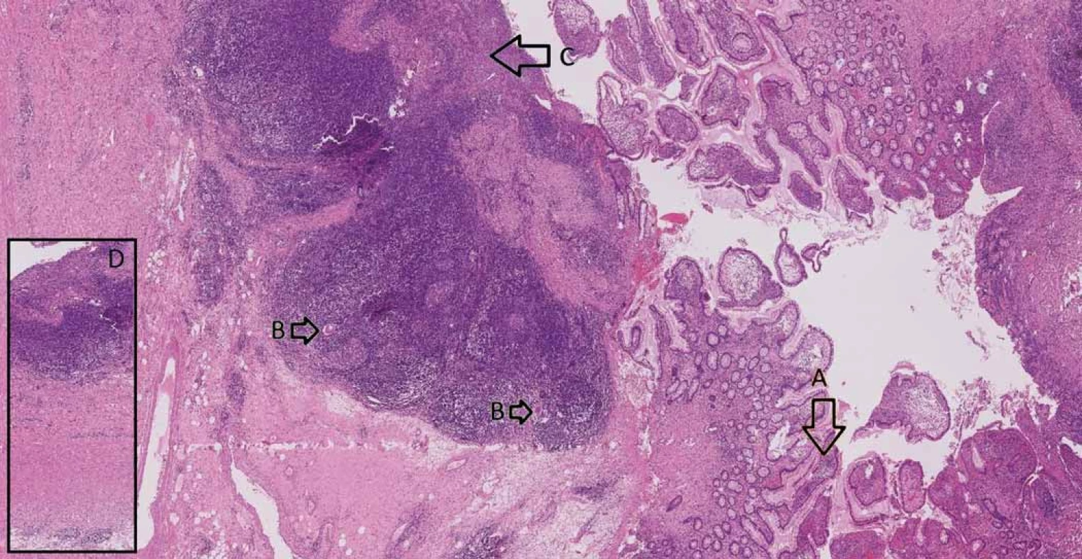 Small intestine with Crohn’s disease – A. architectural distortion of mucosa, B. giant cells, C. ulceration,
D. transmural inflammation.<br>
Obr. 3. Tenké střevo postižené Crohnovou nemocí – A. distorze architektoniky sliznice, B. mnohojaderné buňky, C. ulcerace,
D. transmurální zánět.