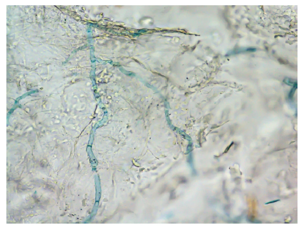Nález hyf Trichophyton erinacei v přímé mikroskopii
kožních šupin z ložiska u pacientky 2 – louhový preparát (10%
KOH + Parkerův inkoust); zvětšení 400krát