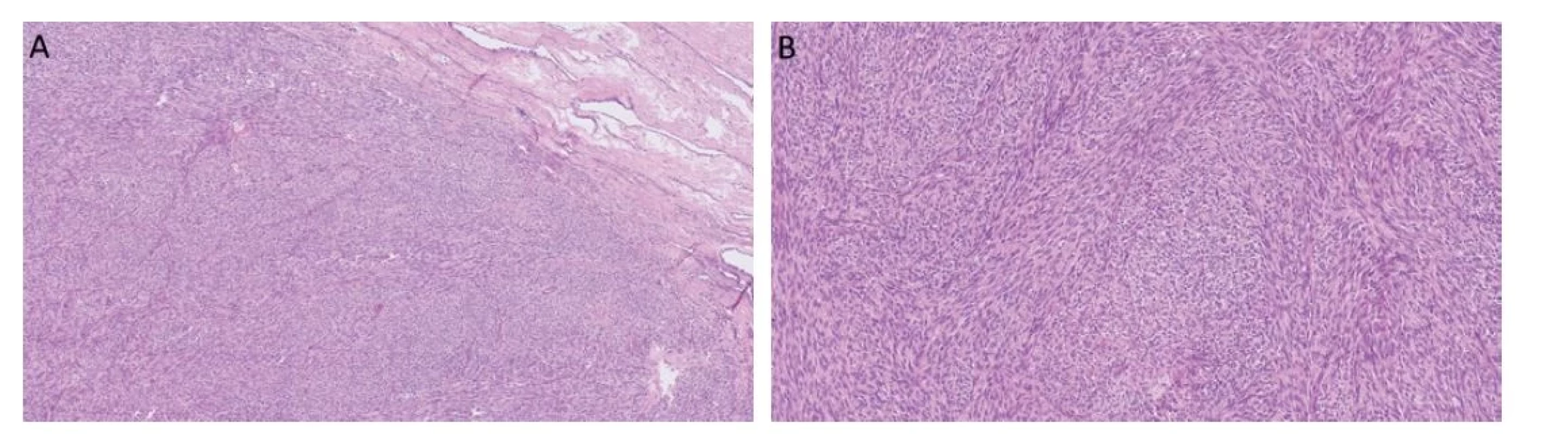 Myoidní gonadální stromální tumor roste solidně, je celulární a často se vyskytuje v blízkosti rete testis (A). Nádorové buňky jsou vřetenité
a fascikulárně uspořádané (B).