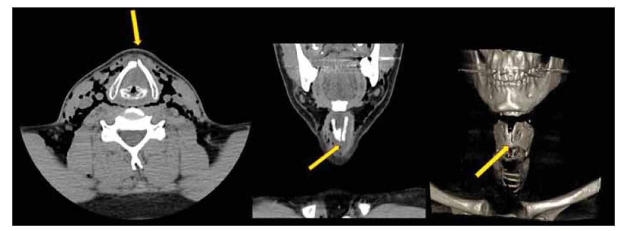 Kazuistika 4 – CT krku nativní, axiální rovina, koronální rovina, 3D rekonstrukce. Neúplná zlomenina chrupavky
štítné vlevo, podkožní emfyzém.<br>
Fig. 2. Case report 4 – CT of the neck native, axial plane, coronaly plane, 3D reconstruction. Incomplete fracture of the left
thyroid cartilage, subcutaneous emphysema.