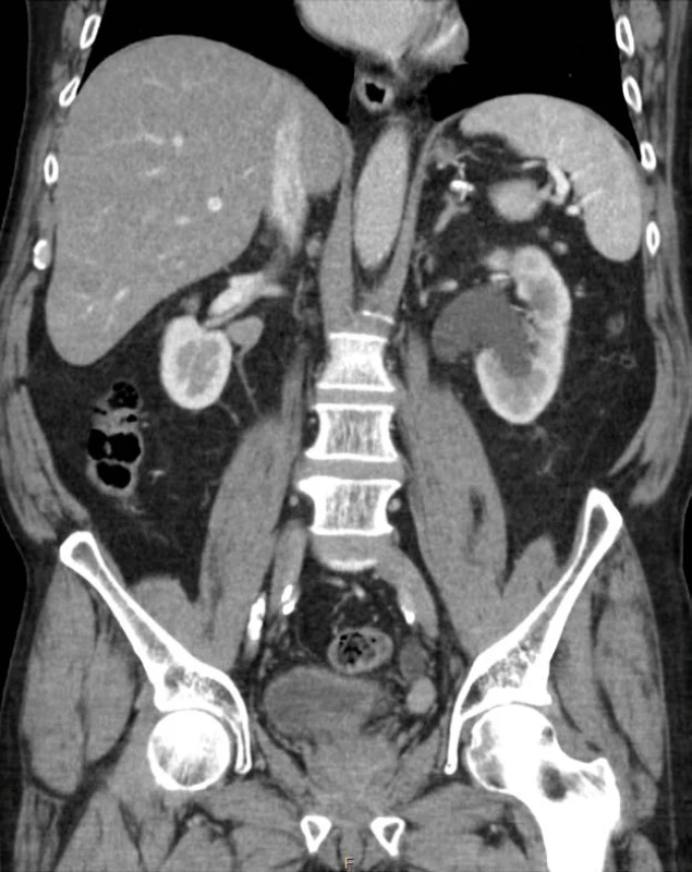CT-IVU – tumor distálního
močovodu vlevo na koronárním řezu
(zdroj: Krajská zdravotní, a. s.)<br>
Fig. 2. CT-IVU – tumor of left distal
ureter (frontal plane)