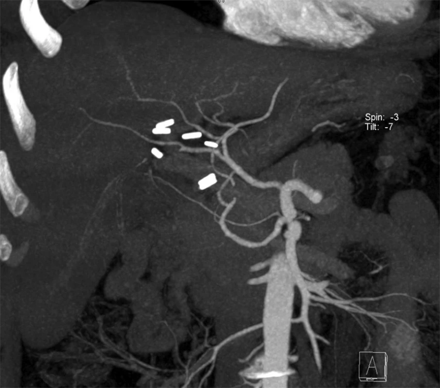 CT angiography confirming the absence of vascular injury